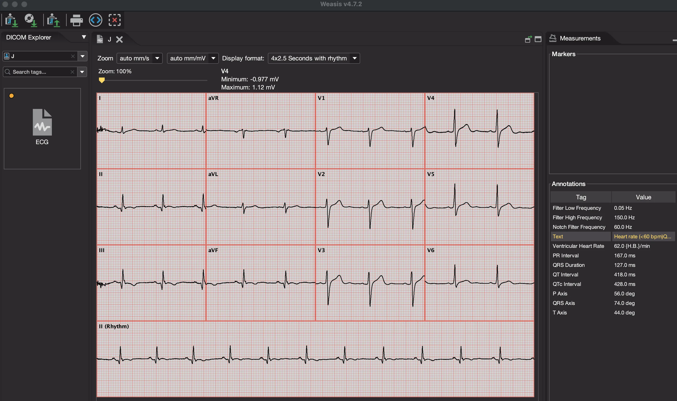 Weasis v4.7.2 開啟 12 導程 ECG DICOM：左為 DICOM Explorer，中央為波形，右側 Measurements 面板列出 Annotations